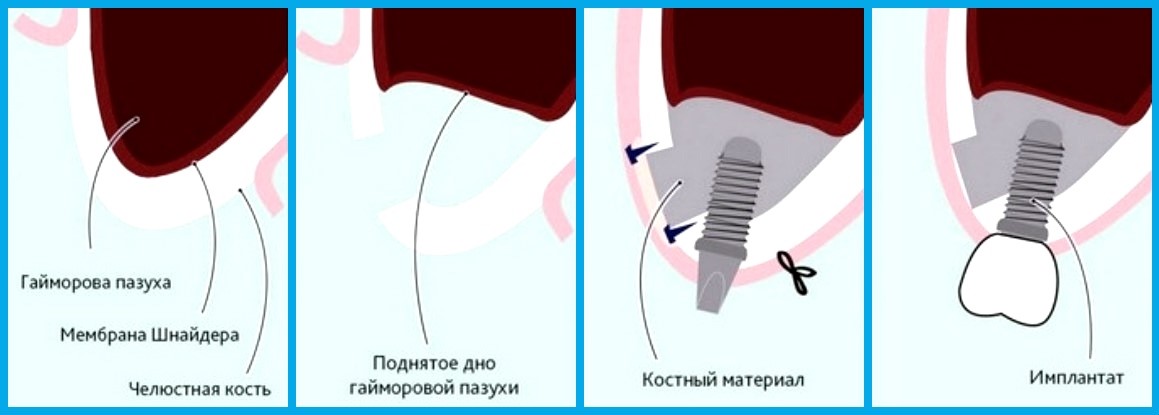 Лифтинг мембраны /устройство для гидравлического подъема мембраны/
